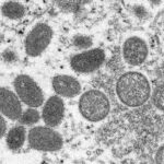 【緊急朗報】新型天然痘のサル痘、日本で急拡大はしない模様　「日本人はサルに近いので天然抗体あり」  [127398796]