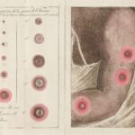 新型天然痘、イギリスで子供たちに感染拡大  [422186189]
