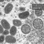 サル痘 世界で550人以上の感染者　東京大阪の男女オワコン　ブツブツ跡が顔に残る NHK  [144189134]